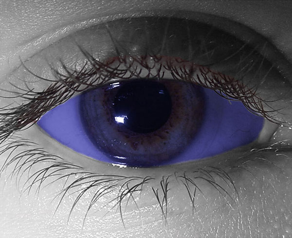  contact lenses